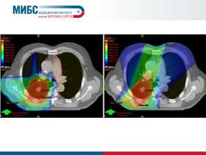 Лучевая терапия два раза в день снижает смертность от рака головы и шеи