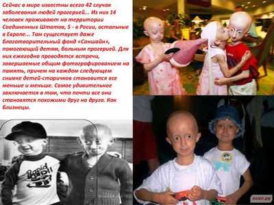 Прогерия: гонка на часах, чтобы помочь маленьким пациентам со старым сердцем