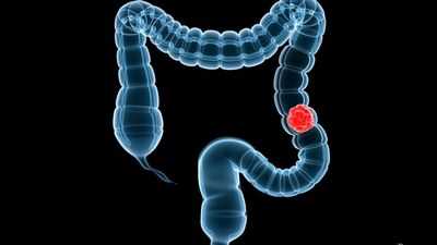 Обнаружены генные мутации, которые приводят к более агрессивному колоректальному раку у афроамериканцев