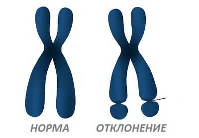 Открытие может привести к новым методам лечения синдрома ломкой Х-хромосомы