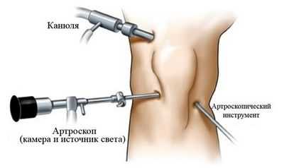 Инновационная концепция лечения коленного хряща