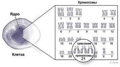 Синдром Дауна: закулисная генетика, лейкемия