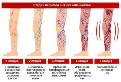 Укрепление бедра может облегчить боль при закупорке артерий ног