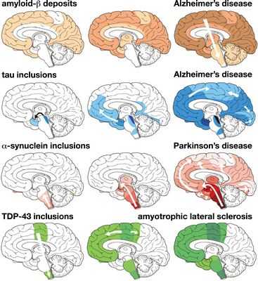 Осада бета-амилоида, ключевого белка при болезни Альцгеймера