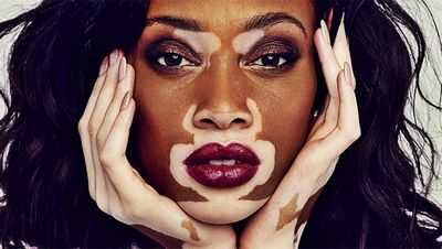 Обнаружена редкая генетическая мутация, вызывающая болезнь у инуитов