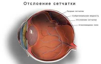 Понимание вероятности развития отслоения сетчатки после открытых травм глаза