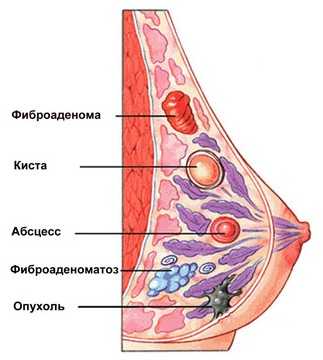 Биомаркер связан с агрессивным раком груди, плохими результатами у афроамериканцев