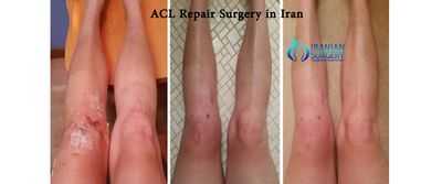 Хирургия - лучший вариант лечения некоторых травм подколенного сухожилия