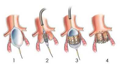 Повторная стернотомия для безопасного протезирования аортального клапана для восьмидесятилетних пациентов