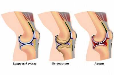 Больше доказательств того, что артрит / обезболивающие могут способствовать смерти от инсульта