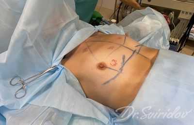 Четверть пациентов перенесла последующую операцию после операции по сохранению груди