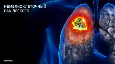 FDG PET оценивает иммунотерапию немелкоклеточного рака легкого: молекулярная визуализация используется для мониторинга новой иммунотерапии, которая направлена ​​на ограничение способности опухолей отключать иммунные клетки, борющиеся с раком