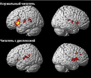 Различия мозга у детей с дислексией, дисграфией