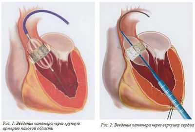 Операция на сердце? TAVI, безопасный и эффективный в качестве хирургических клапанов через 2 года у пациентов с низким риском