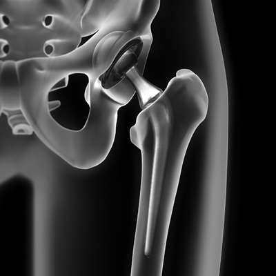 Темнокожие пациенты с большей вероятностью будут повторно госпитализированы после операции по замене тазобедренного сустава или коленного сустава
