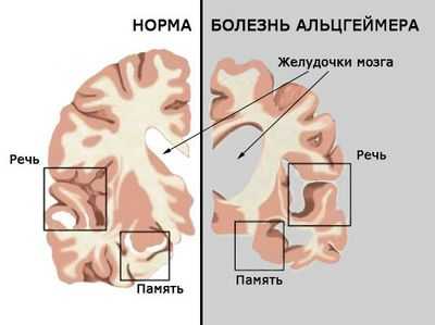 Имплант для профилактики болезни Альцгеймера