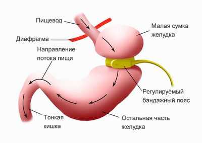 Шунтирование желудка помогает подросткам с тяжелым ожирением поддерживать потерю веса в течение длительного времени