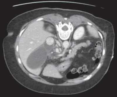 КТ сердца превосходит стресс-тесты в выявлении закупоренных артерий