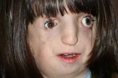 Сходства объединяют три различные генные мутации синдрома Тричера Коллинза