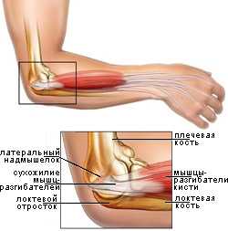 Что составляет хорошее лечение теннисного локтя?